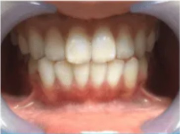 Female, 20 — college student, teeth after one whitening session