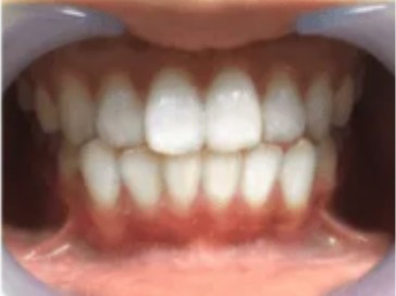 Female, 20 — college student, teeth after four whitening sessions