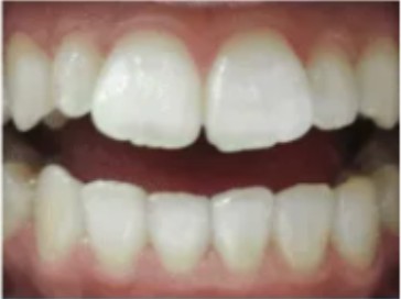 Female, 30 — office worker, teeth after four whitening sessions
