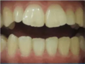Female, 30 — office worker, teeth before whitening
